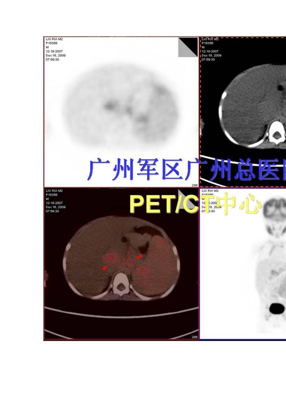 淋巴结指突状细胞肉瘤_第5页