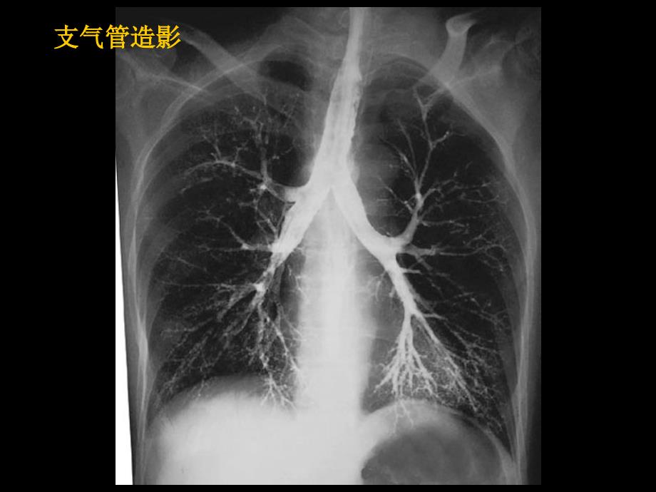 呼吸系统胸片-影像学课件_第4页