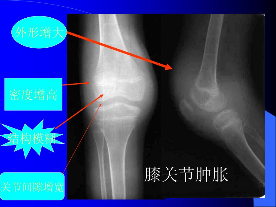 关节及脊柱疼痛性疾病影像学诊断- 广西医科大学_第4页