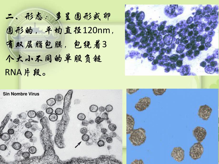 肾综合征出血热医学课件_第4页