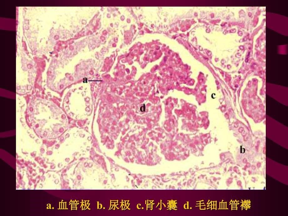 [病理学]泌尿系统疾病_第5页