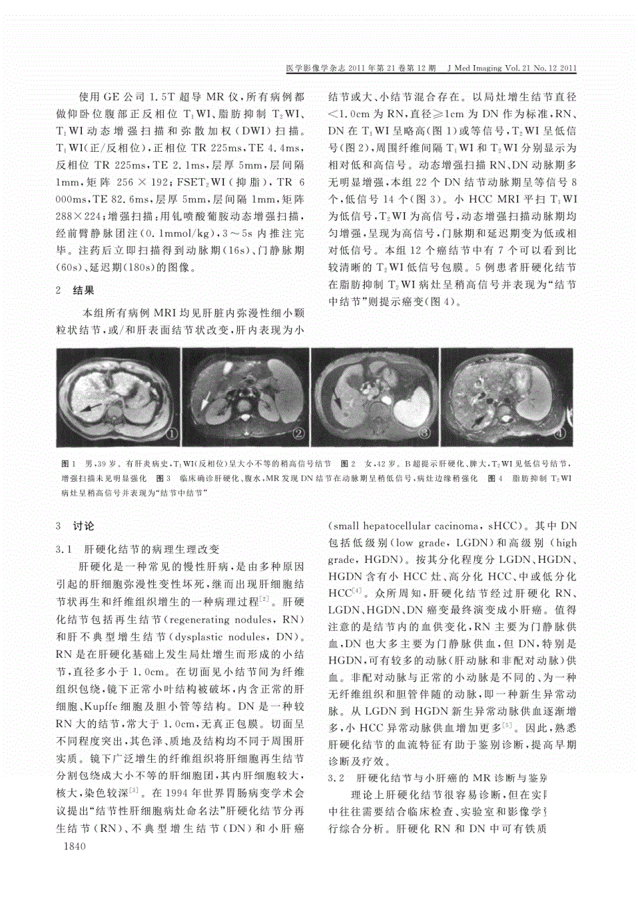 肝硬化结节与小肝癌的MRI_第2页