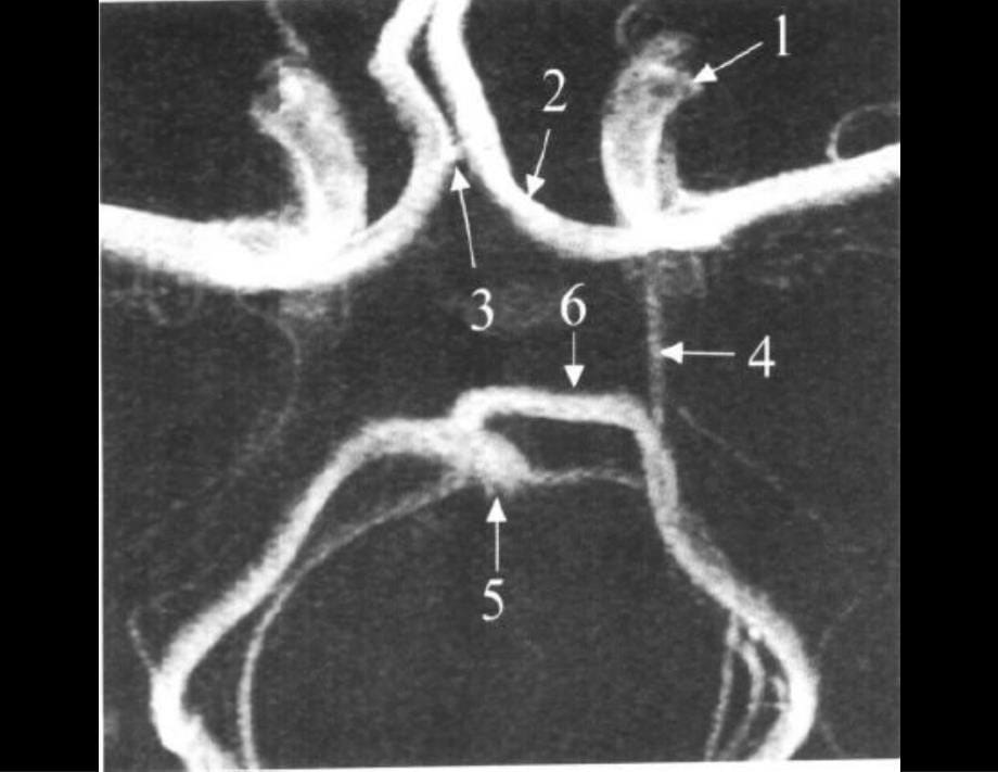 前交通动脉瘤解剖与临床_第5页