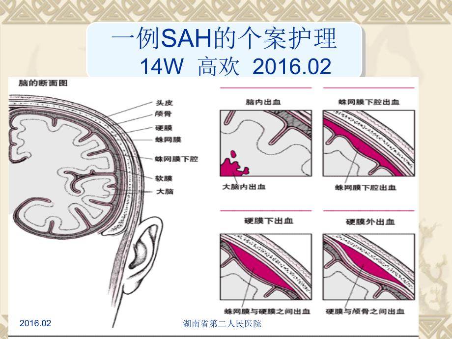 蛛网膜下腔出血的个案护理最终_第1页