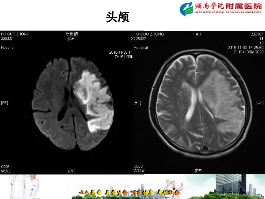 闭塞血管再通介入治疗病例分享(2015)_第3页