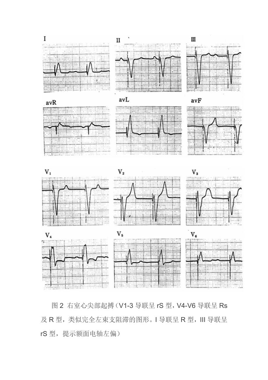 图解心室不同部位起搏心电图_第3页