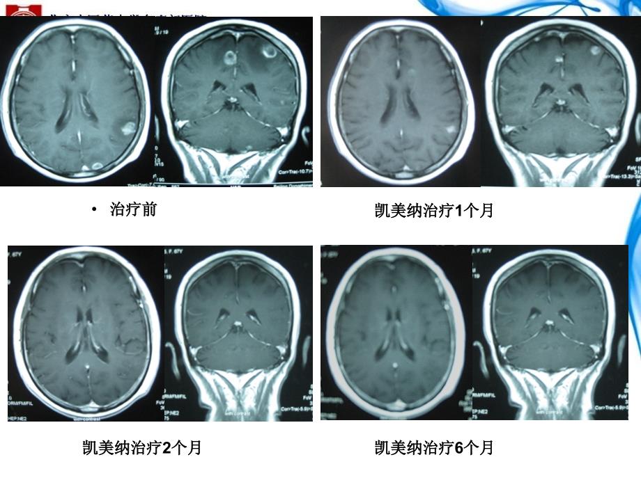 凯美纳治疗肺癌脑转移病例分享_第4页