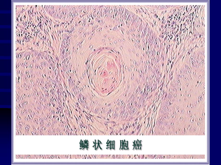 基础医学北大病理学课件恶性上皮性肿瘤_第4页