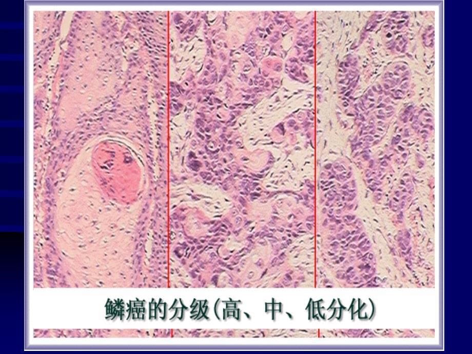 基础医学北大病理学课件恶性上皮性肿瘤_第5页