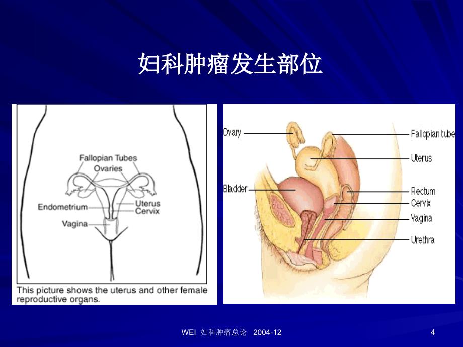 子宫颈上皮内瘤变 与 子宫颈癌_第4页