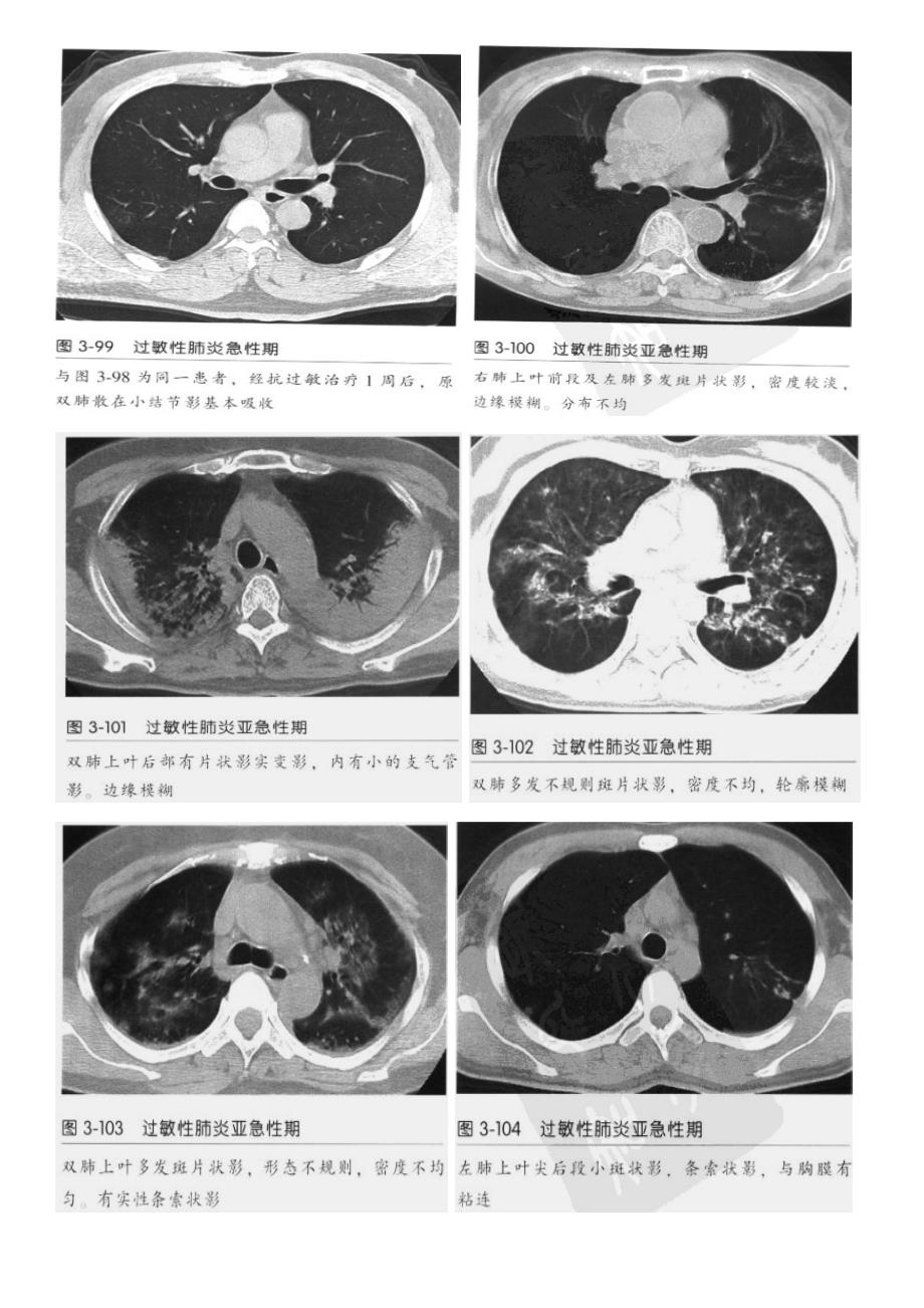 过敏性肺炎ct征象_第3页