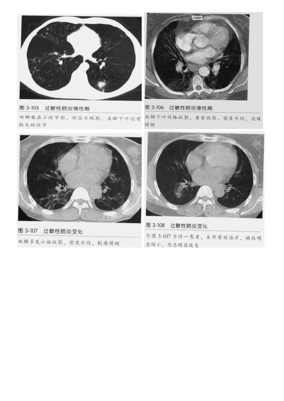 过敏性肺炎ct征象_第4页