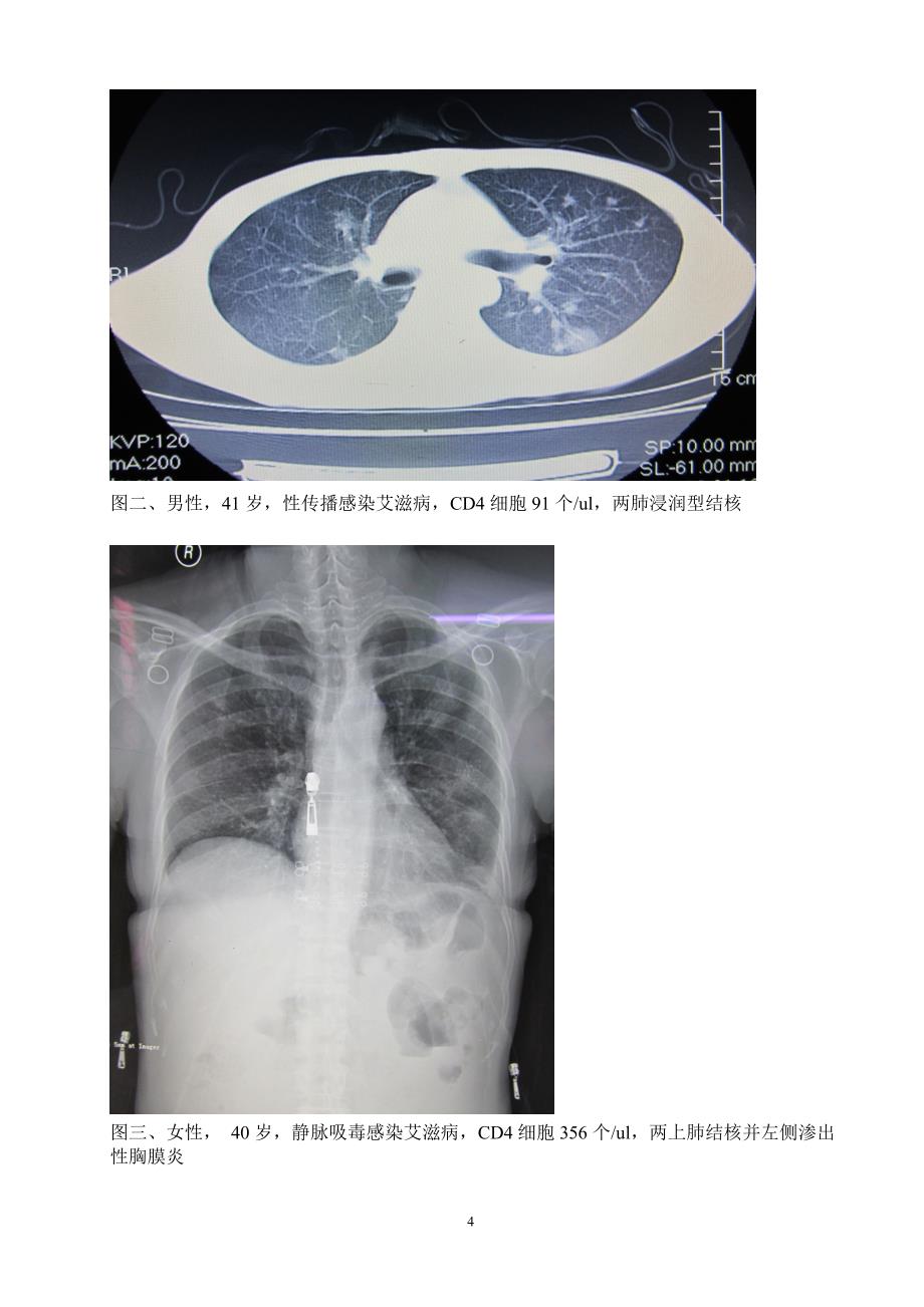 30例艾滋病结核病双重感染病人临床、免疫及影像表现特_第4页