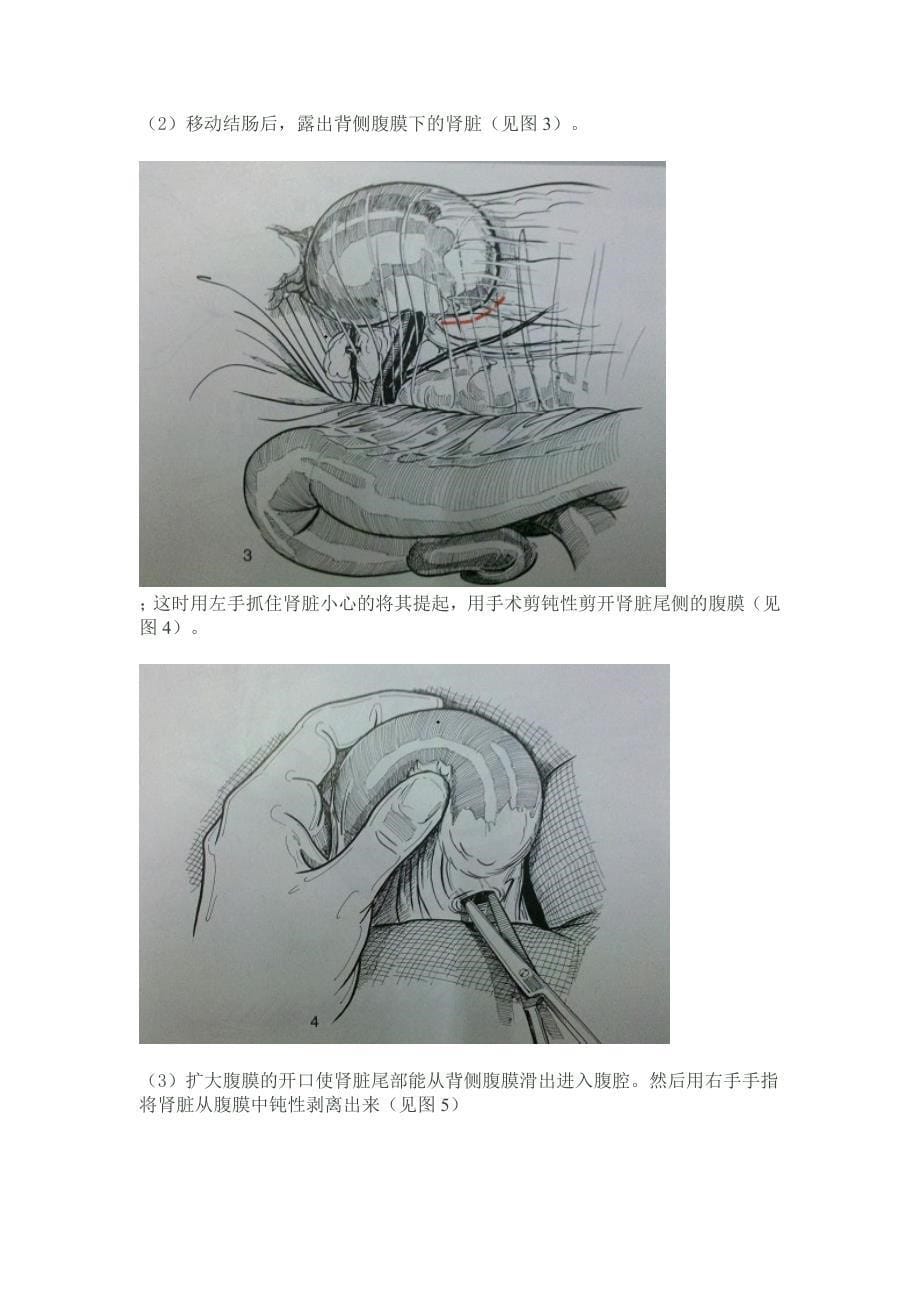 肾结石去除_第5页