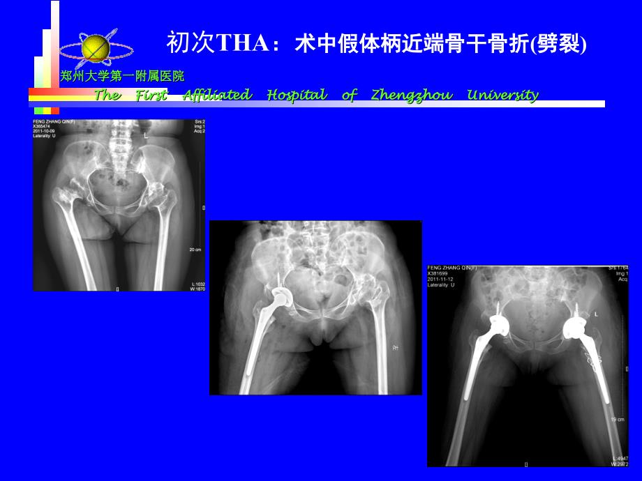 5 王义生-tha术中股骨骨折处理_第2页