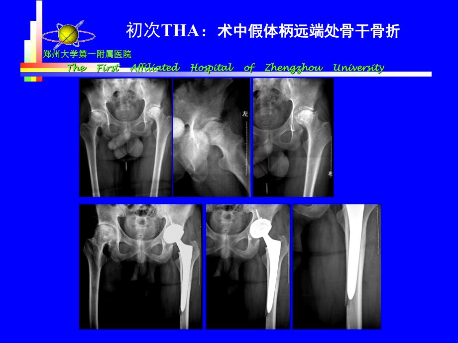 5 王义生-tha术中股骨骨折处理_第3页