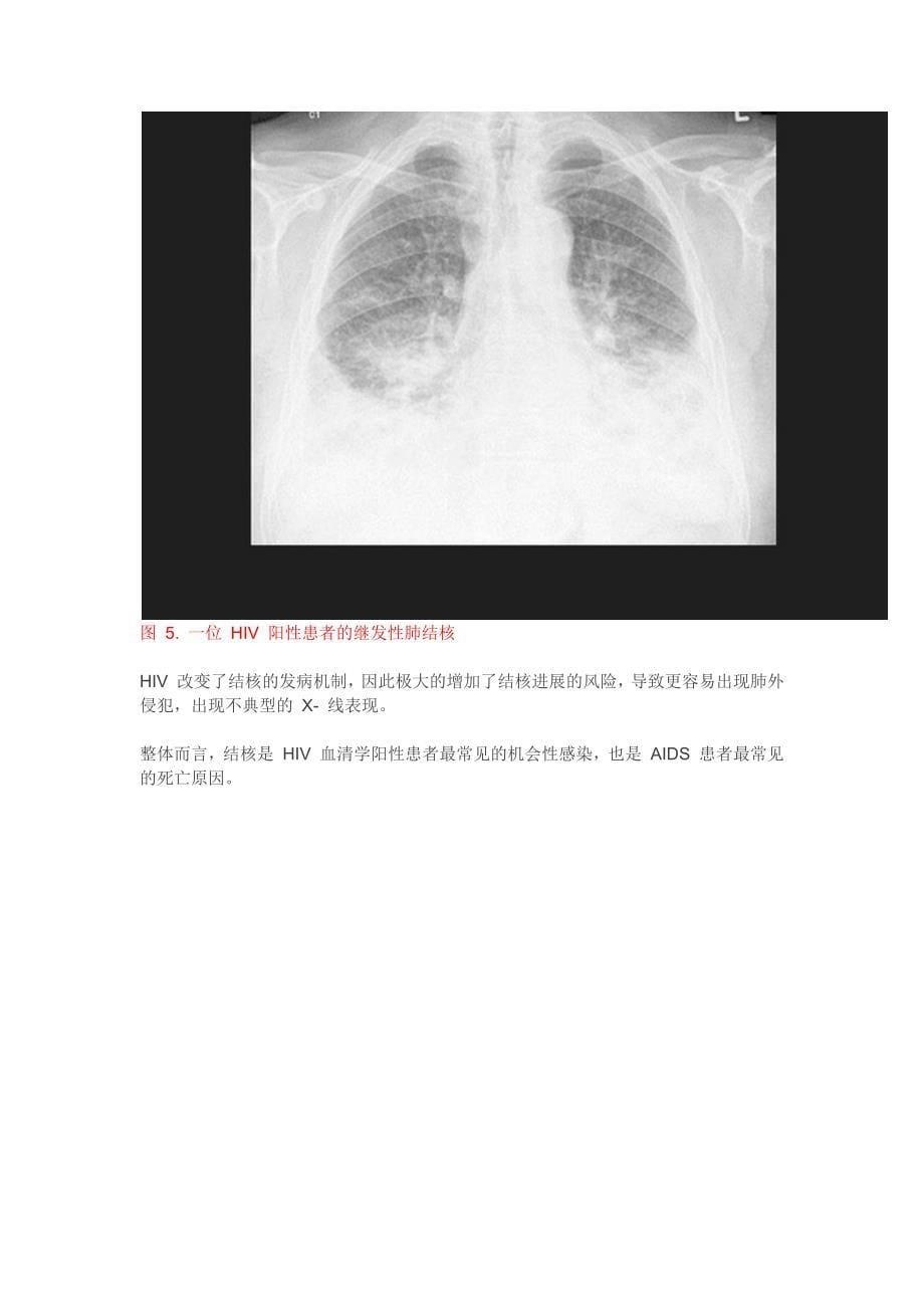 结核病的影像诊断与治疗挑战_第5页