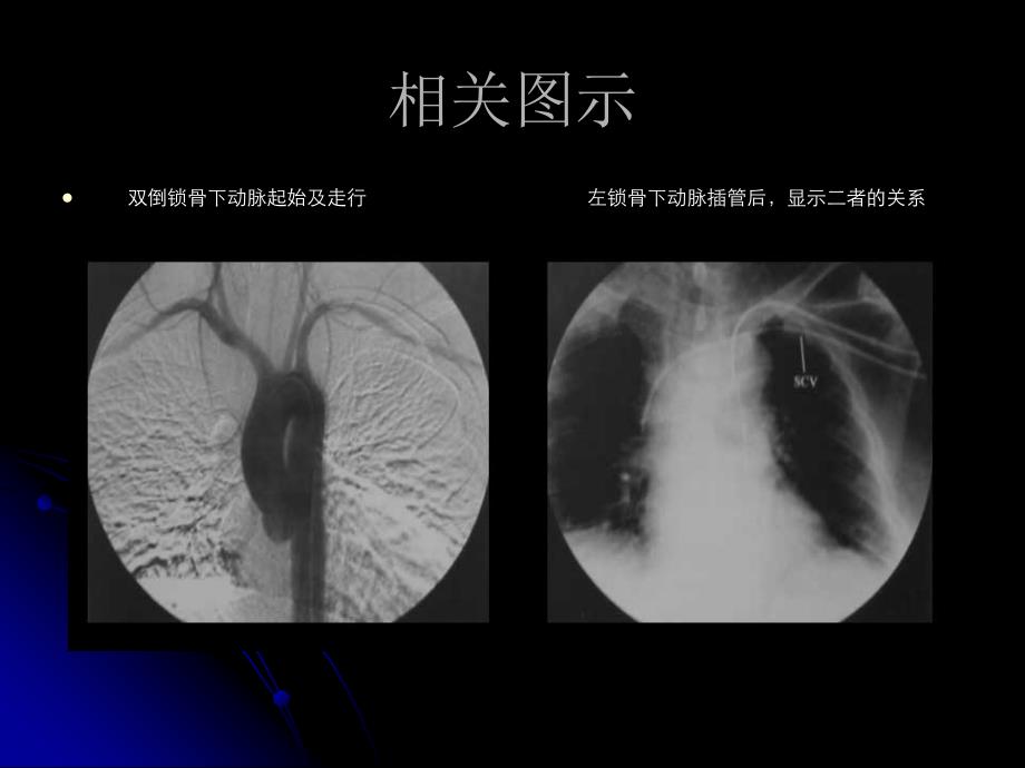 经锁骨下动脉、静脉穿刺插管_第4页