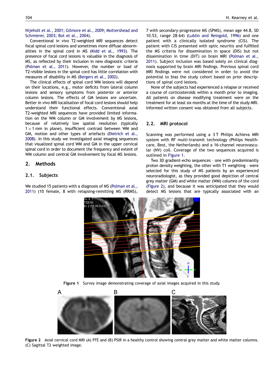 多发性硬化 ,视神经脊髓炎_第2页