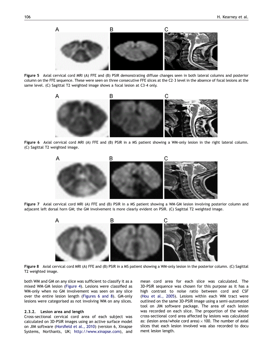 多发性硬化 ,视神经脊髓炎_第4页