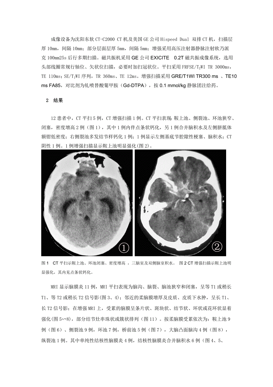 结核性脑膜炎的ct及mri诊断_第2页