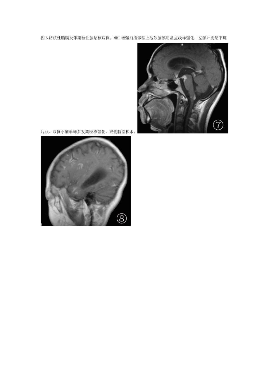 结核性脑膜炎的ct及mri诊断_第5页