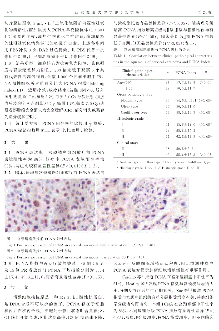 增殖细胞核抗原与宫颈癌病理分级和放射敏感性的关系_第2页