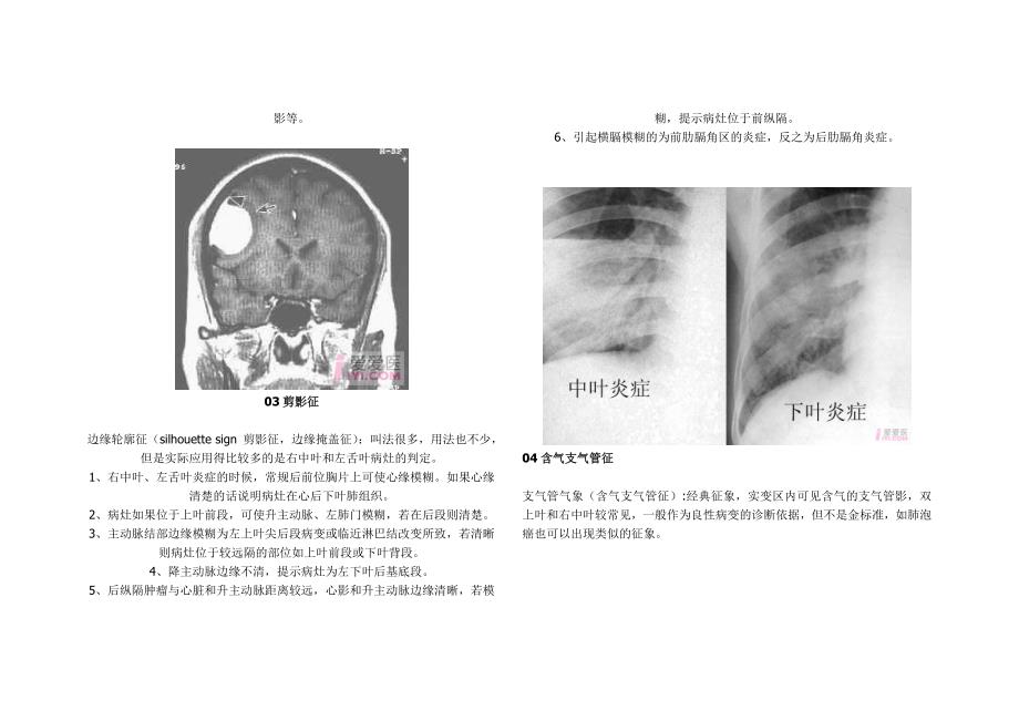 医学影像学各种“征象”综合_第2页