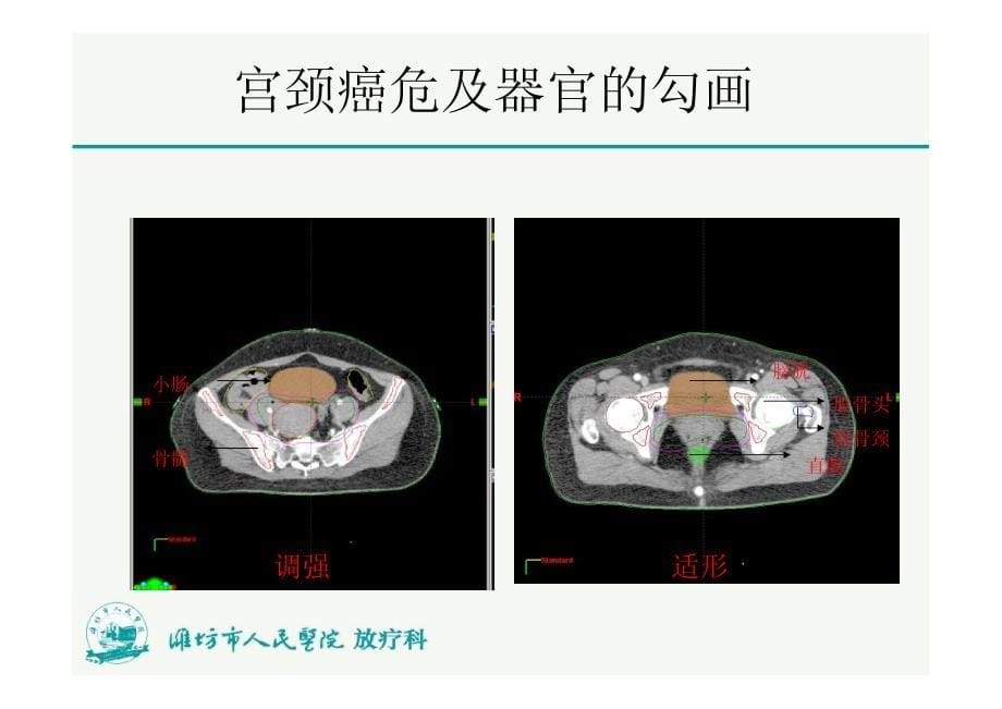 宫颈癌调强放疗计划设计_第5页