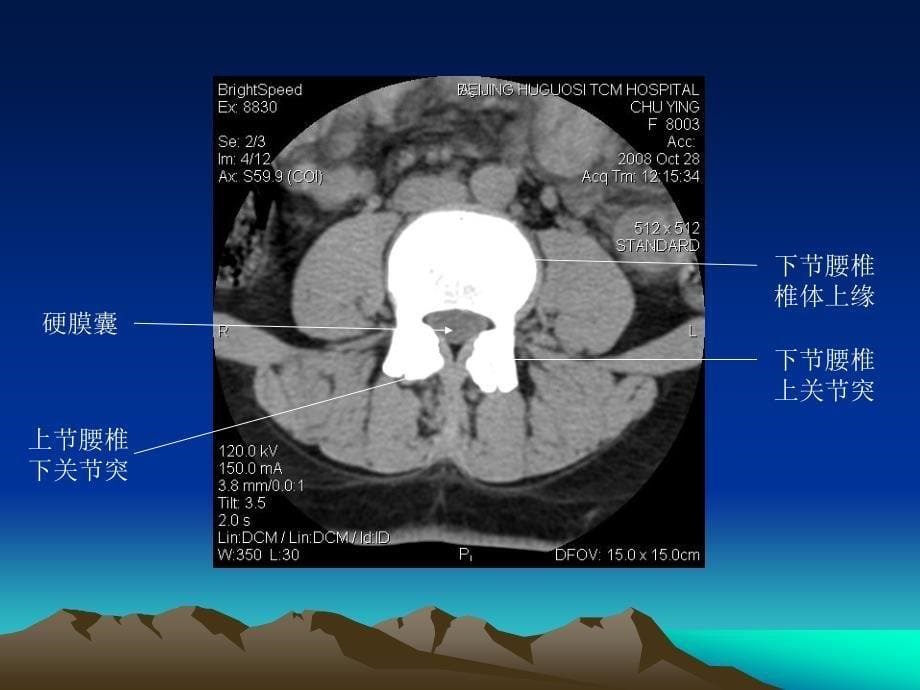 腰椎CT诊断大全新手实用_第5页