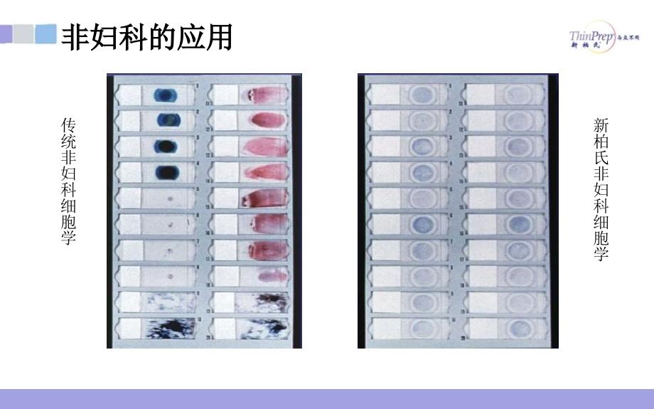 tct在非妇科中的应用_第4页