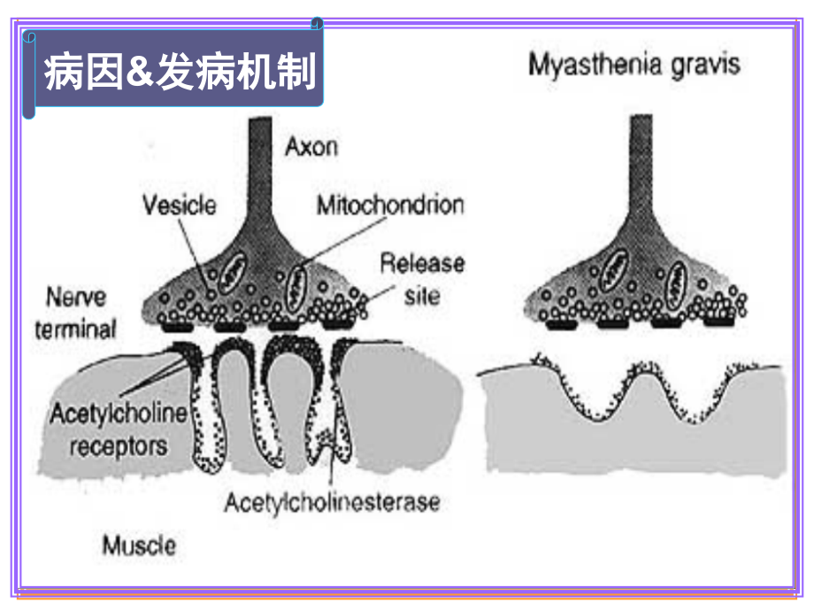 重症肌无力马春姣_第4页