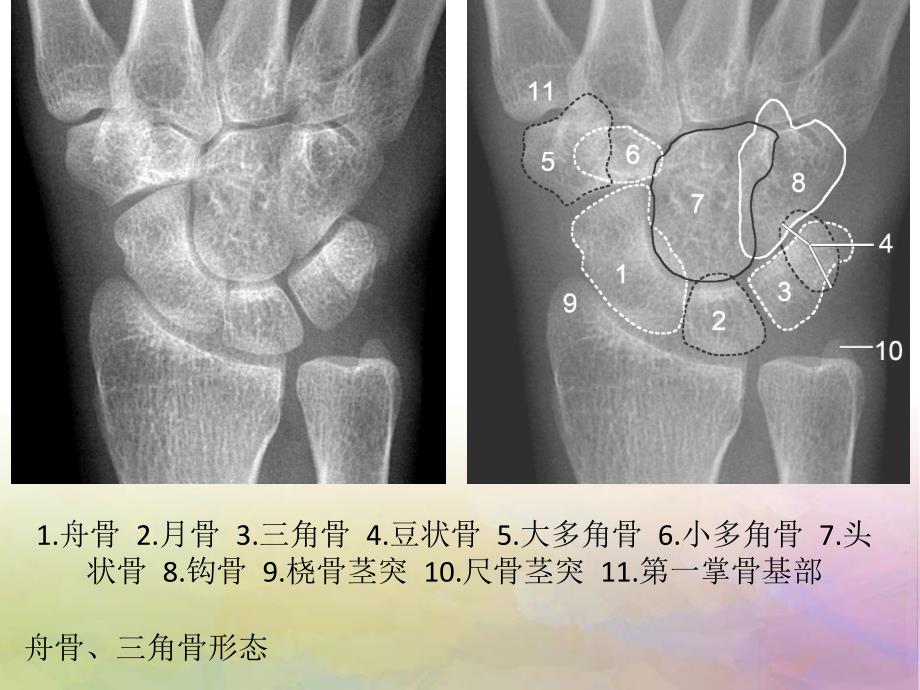 腕关节解剖_第3页