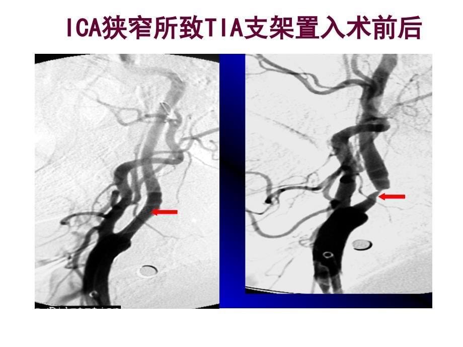 认识与防治缺血性脑卒中_第5页