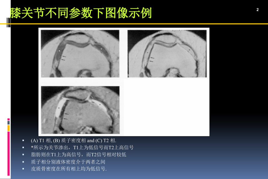 膝关节运动损伤的MRI表现_第2页