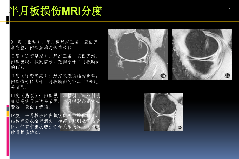 膝关节运动损伤的MRI表现_第4页