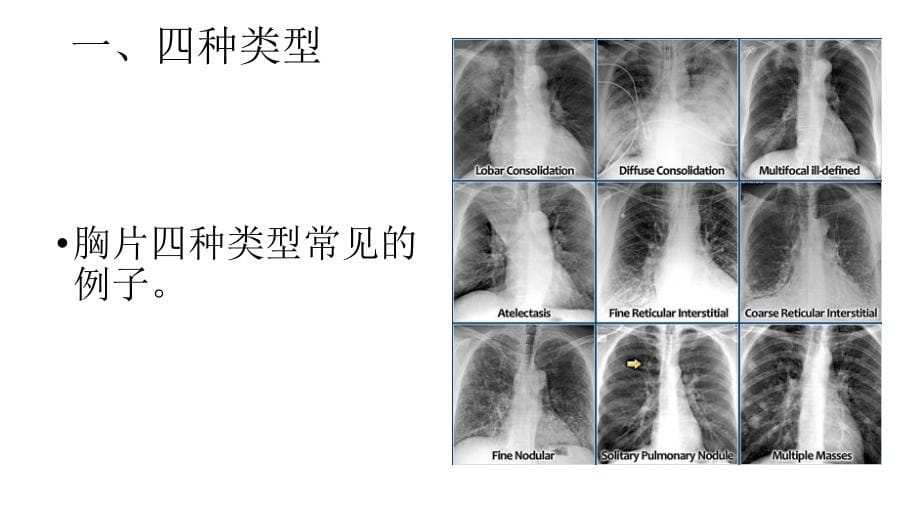 肺疾病胸片表现新建ChestXRayLungdisease2_第5页