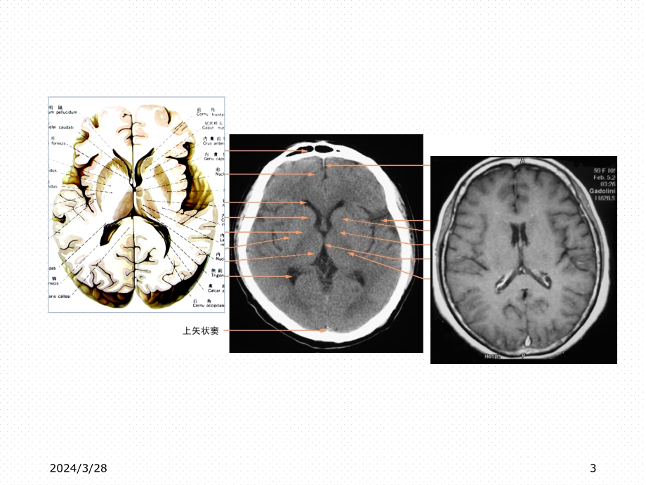 CT基础颅脑正常和基本病变表现_第3页