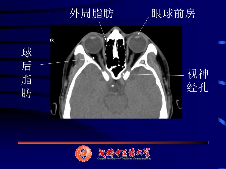 眼耳鼻喉CT解剖_第4页