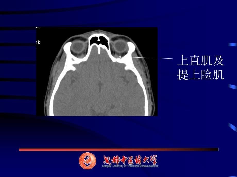 眼耳鼻喉CT解剖_第5页