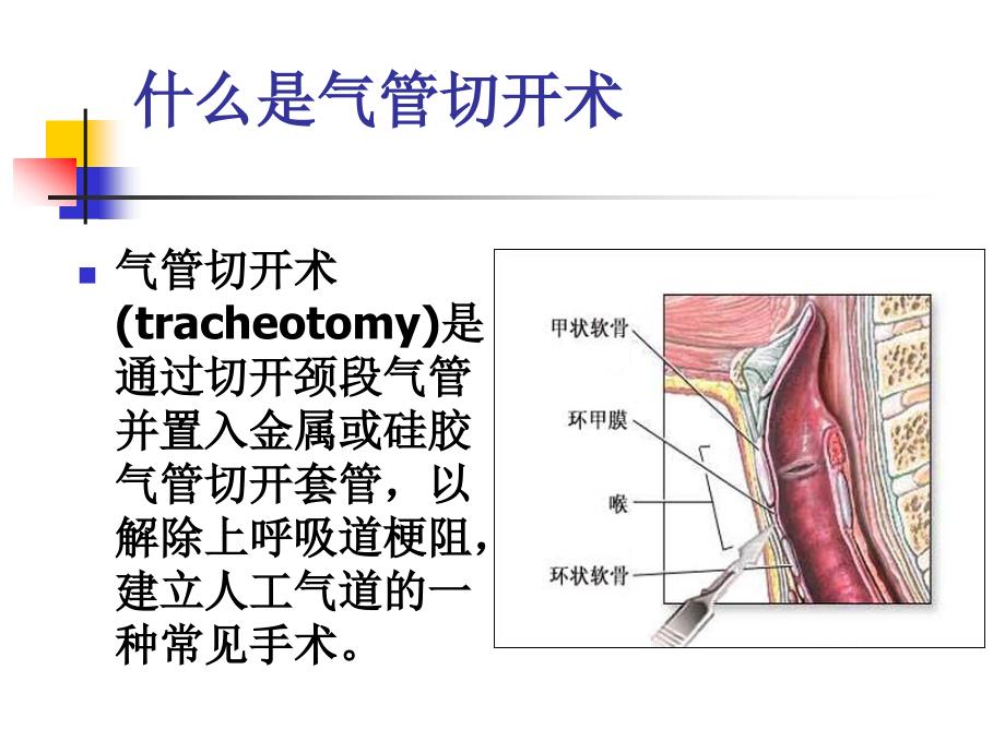 气管切开的护理_第3页