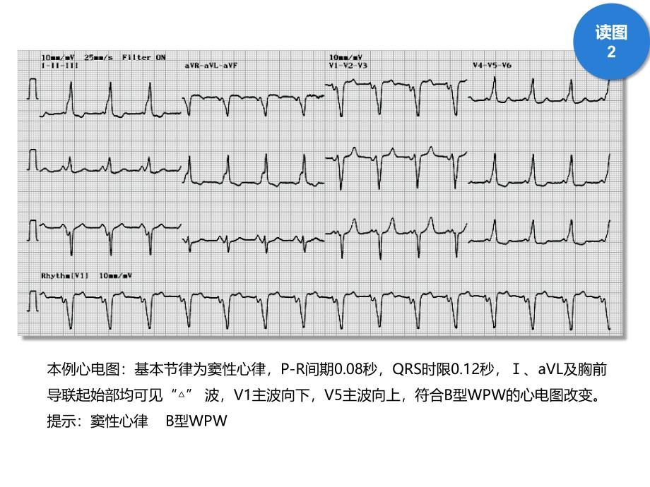 读图识片(预激合并房颤)_第3页