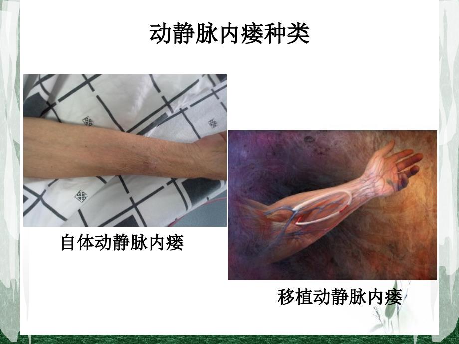 动静脉内瘘顾敏_第4页