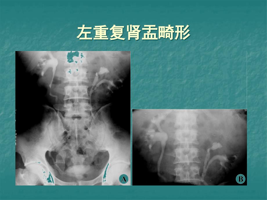 新生儿肾脏先天性发育异常_第4页