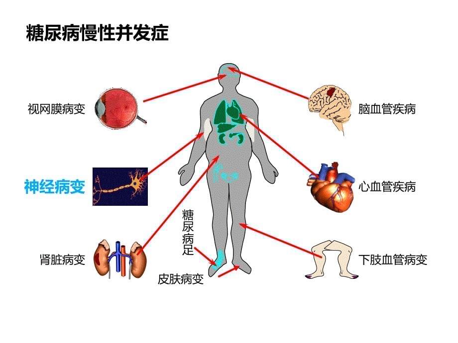 糖尿病神经病变_第5页