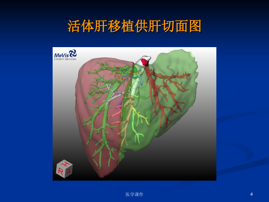 外科学总论之器官移植课件_第4页