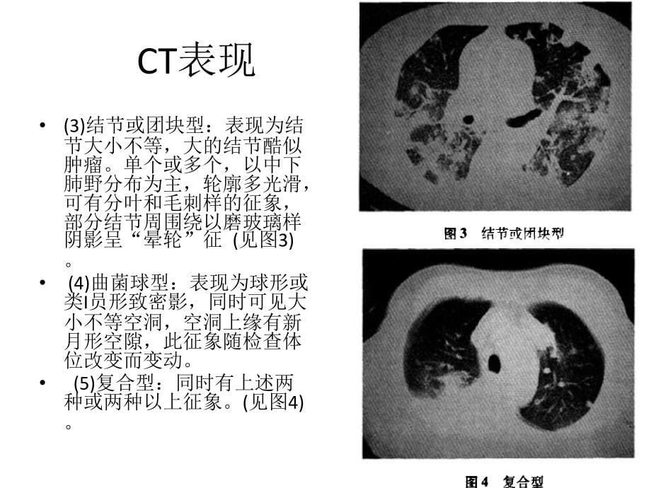 侵袭性肺真菌病_第5页