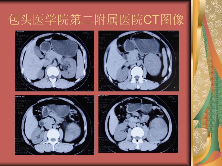 腹膜后非典型性孤立性纤维性肿瘤病例讨论_第4页