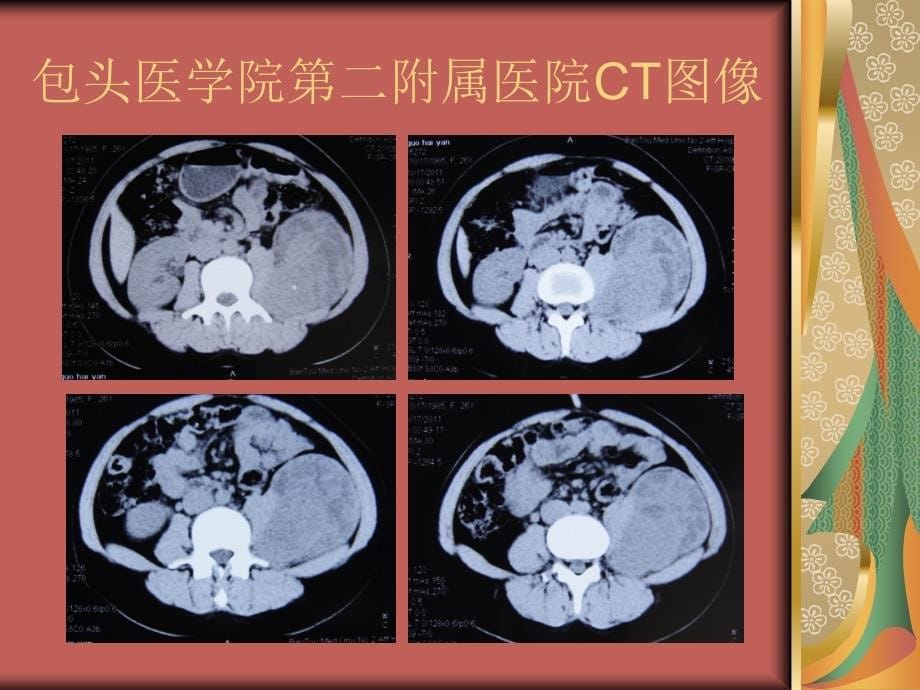 腹膜后非典型性孤立性纤维性肿瘤病例讨论_第5页