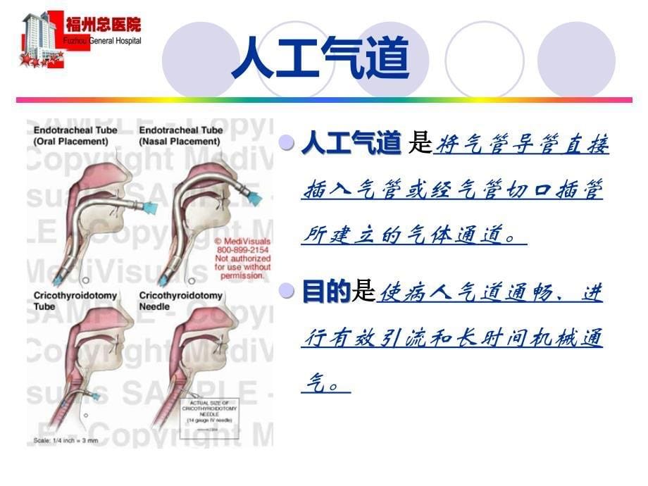 机械通气患者人工气道的选择_第5页